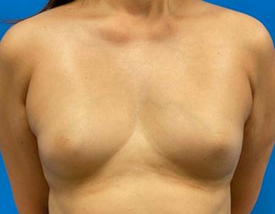 Breast Augmentation Before & After Gallery - Patient 360720 - Image 1