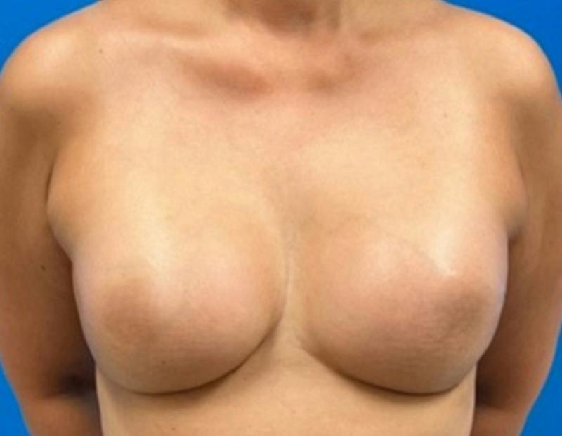 Breast Augmentation Before & After Gallery - Patient 360720 - Image 2