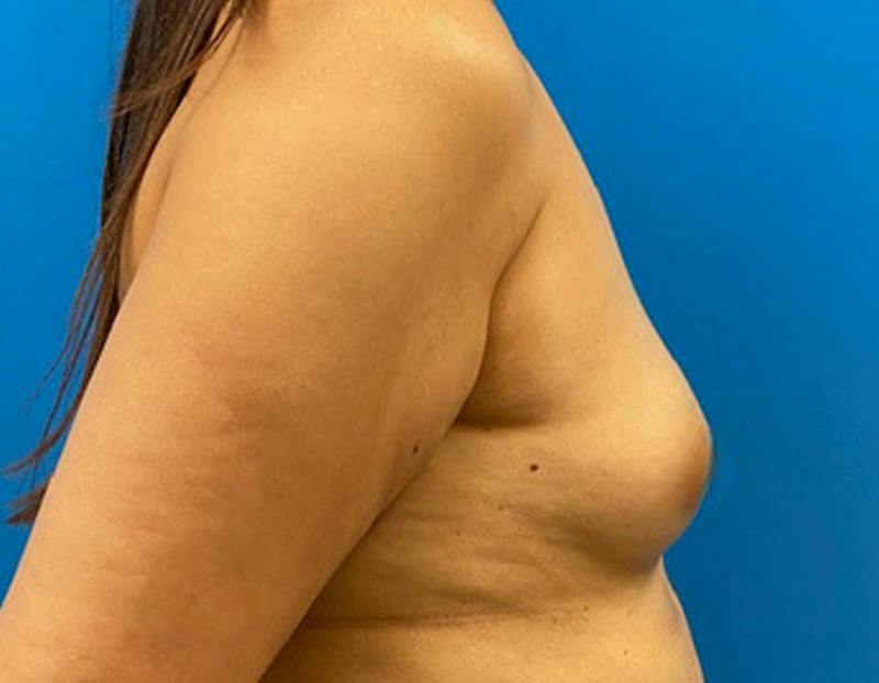 Breast Augmentation Before & After Gallery - Patient 360720 - Image 5