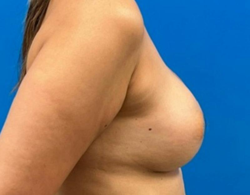 Breast Augmentation Before & After Gallery - Patient 360720 - Image 6