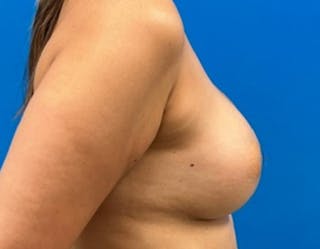 Breast Augmentation Before & After Gallery - Patient 360720 - Image 6
