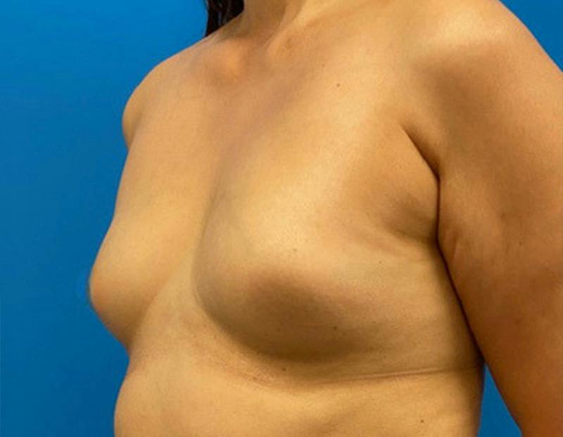 Breast Augmentation Before & After Gallery - Patient 360720 - Image 7