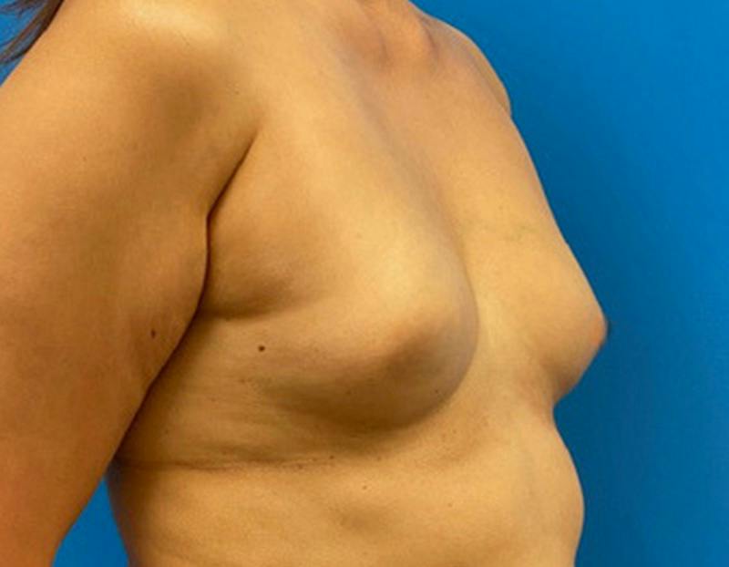 Breast Augmentation Before & After Gallery - Patient 360720 - Image 3