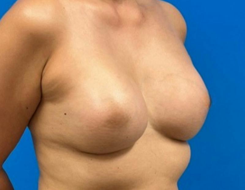 Breast Augmentation Before & After Gallery - Patient 360720 - Image 4