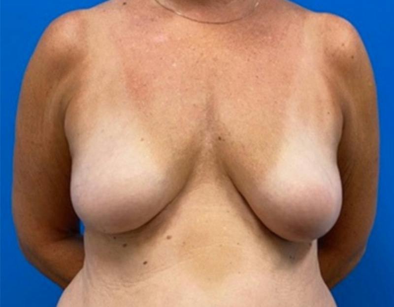 Breast Augmentation Before & After Gallery - Patient 150718 - Image 1