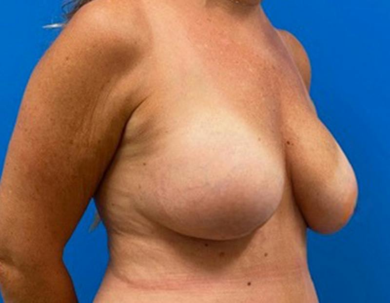 Breast Augmentation Before & After Gallery - Patient 150718 - Image 4