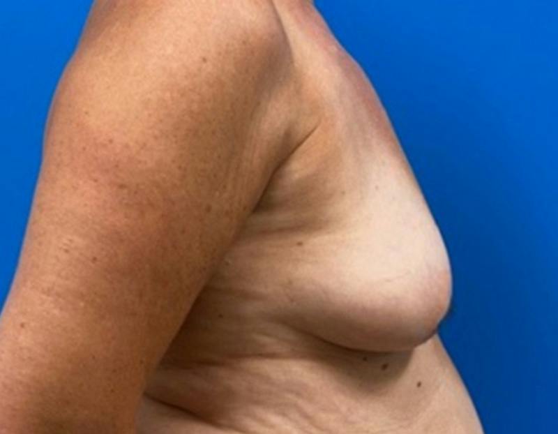 Breast Augmentation Before & After Gallery - Patient 150718 - Image 5