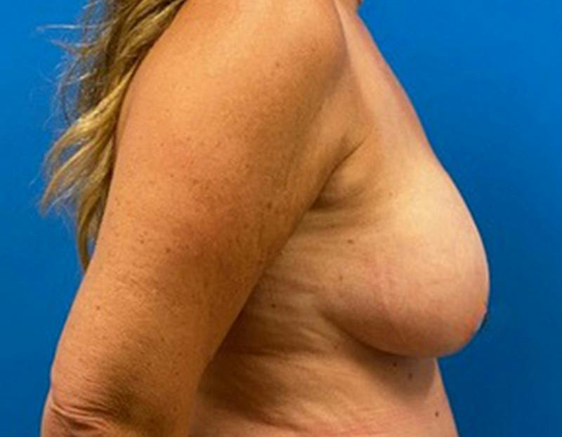 Breast Augmentation Before & After Gallery - Patient 150718 - Image 6