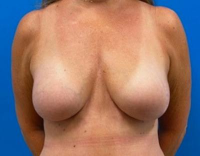 Breast Augmentation Before & After Gallery - Patient 150718 - Image 2