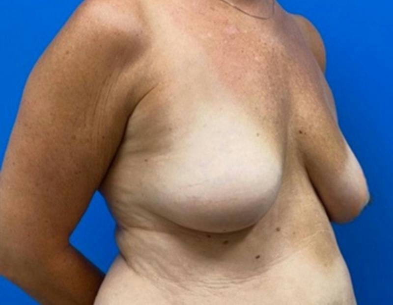 Breast Augmentation Before & After Gallery - Patient 150718 - Image 3