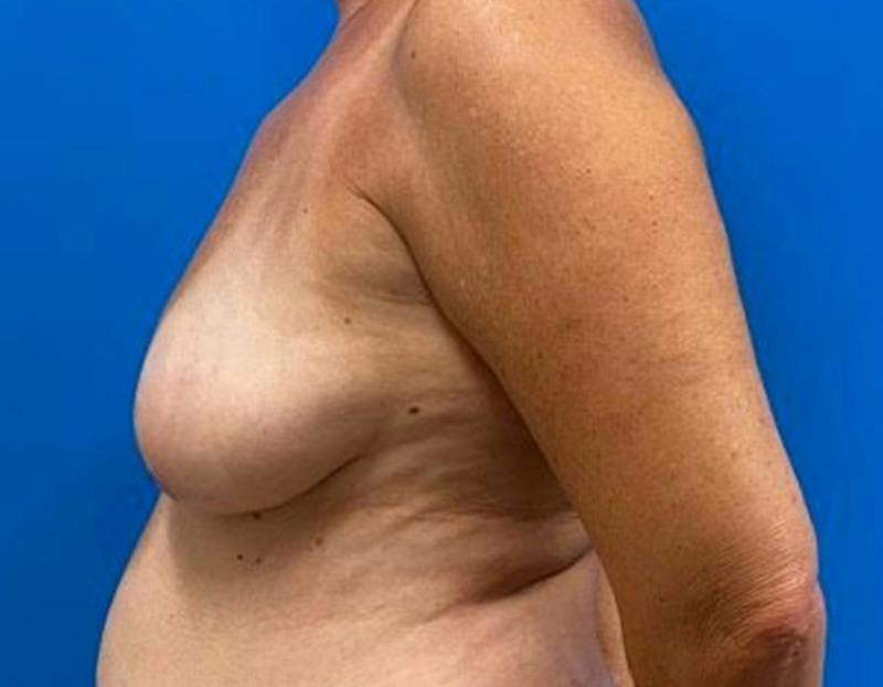 Breast Augmentation Before & After Gallery - Patient 150718 - Image 9