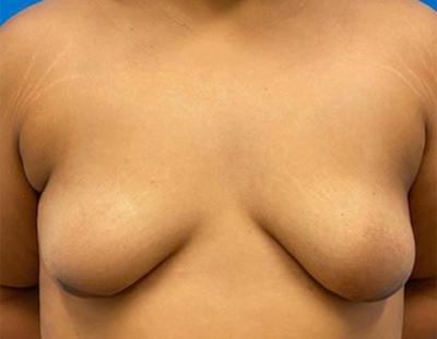 Breast Augmentation Before & After Gallery - Patient 374116 - Image 1