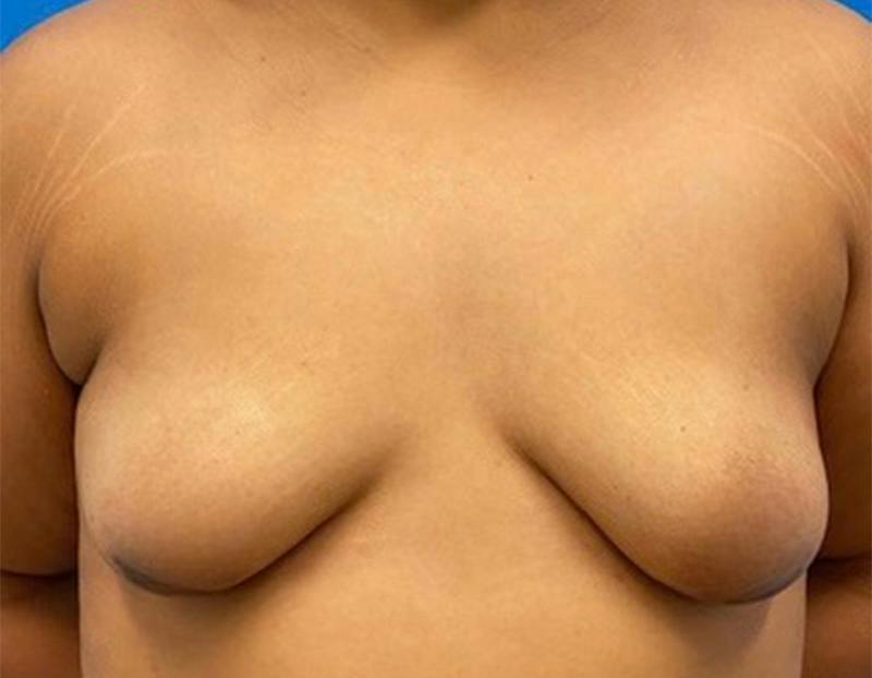 Breast Augmentation Before & After Gallery - Patient 374116 - Image 1