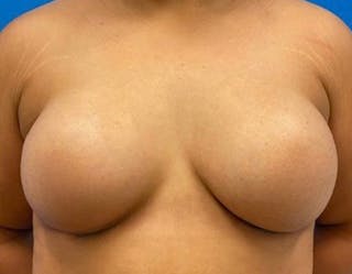 Breast Augmentation Before & After Gallery - Patient 374116 - Image 2