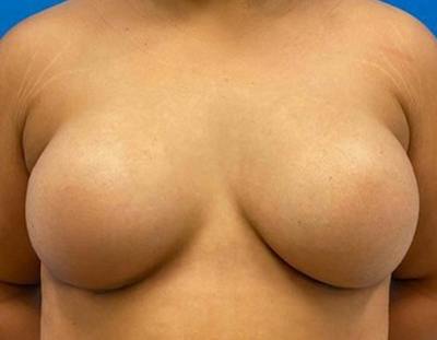 Breast Augmentation Before & After Gallery - Patient 374116 - Image 2