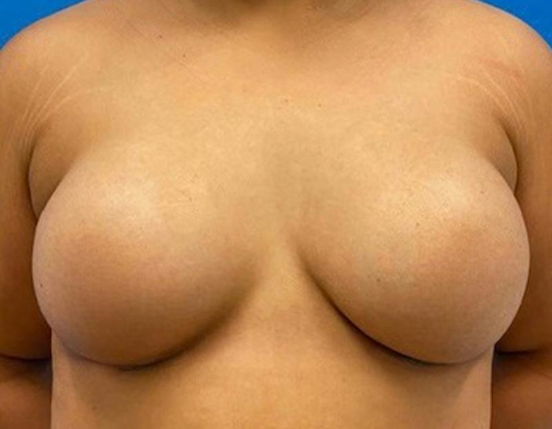 Breast Augmentation Before & After Gallery - Patient 374116 - Image 2
