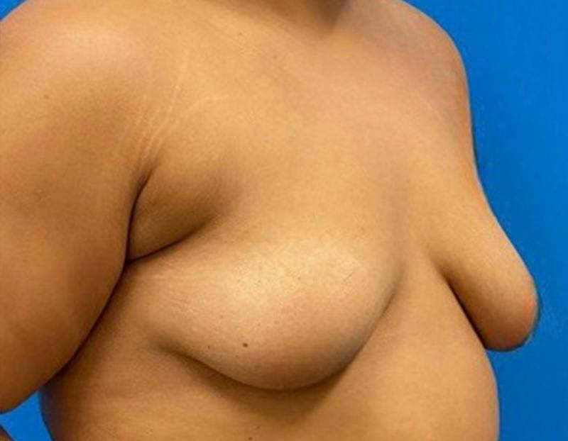 Breast Augmentation Before & After Gallery - Patient 374116 - Image 3