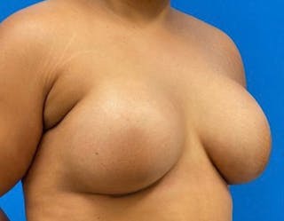 Breast Augmentation Before & After Gallery - Patient 374116 - Image 4