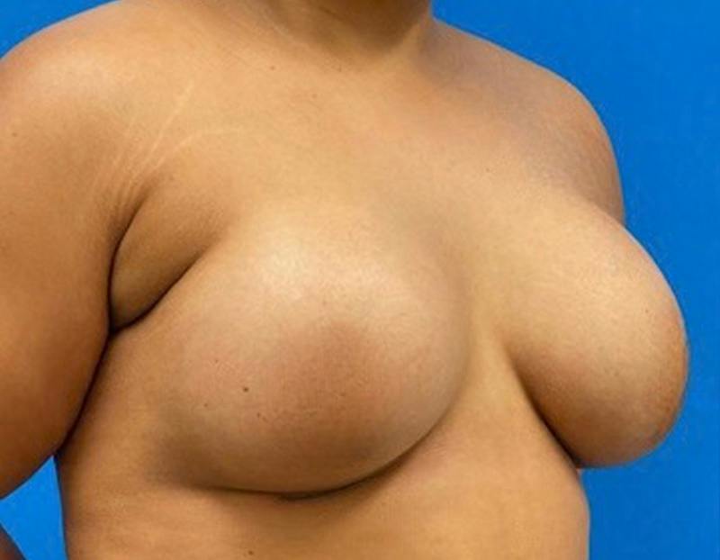 Breast Augmentation Before & After Gallery - Patient 374116 - Image 4
