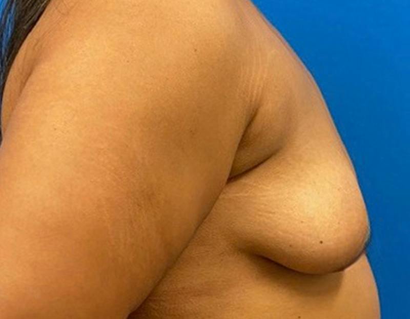 Breast Augmentation Before & After Gallery - Patient 374116 - Image 5