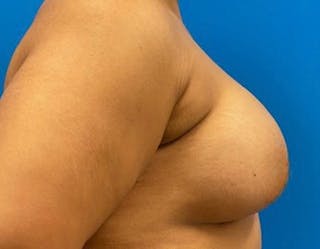 Breast Augmentation Before & After Gallery - Patient 374116 - Image 6
