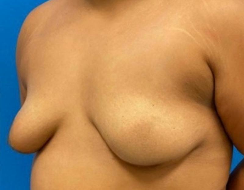 Breast Augmentation Before & After Gallery - Patient 374116 - Image 7