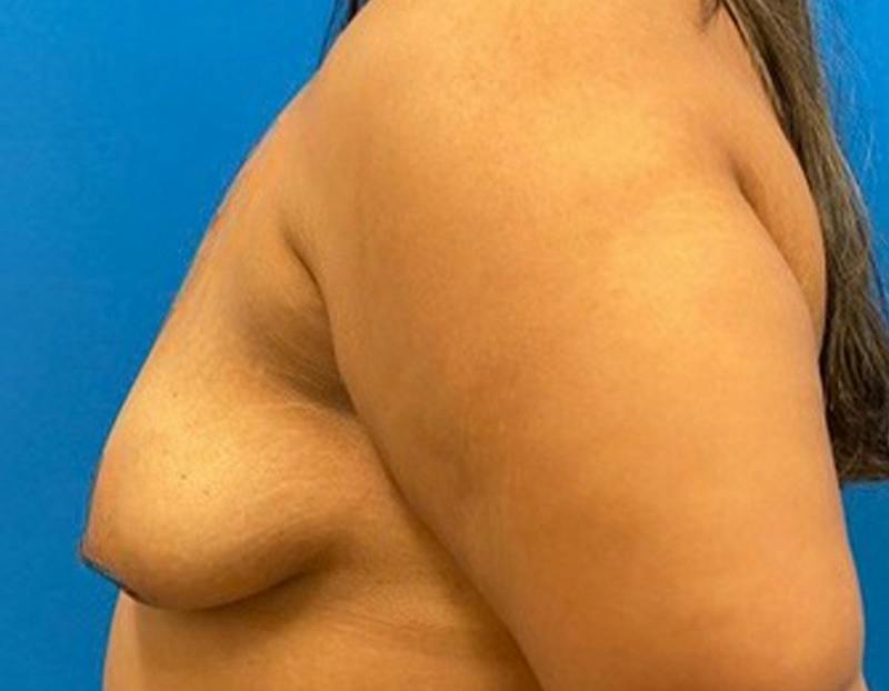 Breast Augmentation Before & After Gallery - Patient 374116 - Image 9