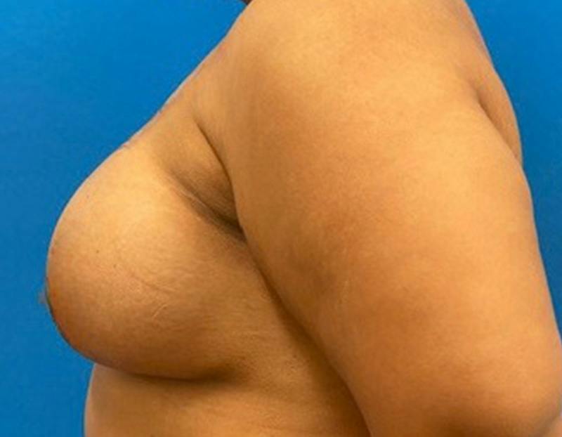 Breast Augmentation Before & After Gallery - Patient 374116 - Image 10