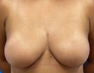 Breast Augmentation Before & After Gallery - Patient 409272 - Image 2