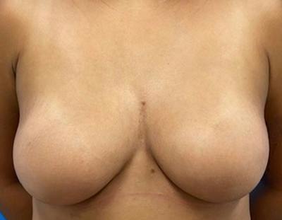 Breast Augmentation Before & After Gallery - Patient 409272 - Image 2