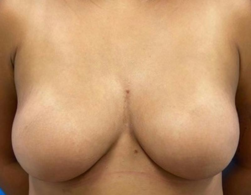 Breast Augmentation Before & After Gallery - Patient 409272 - Image 2