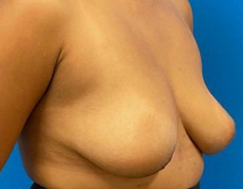 Breast Augmentation Before & After Gallery - Patient 409272 - Image 3