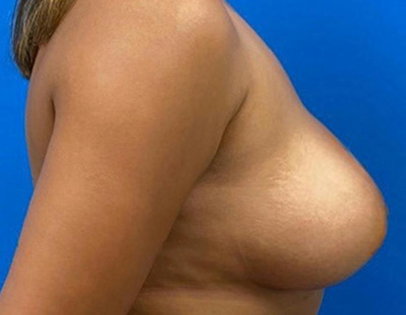 Breast Augmentation Before & After Gallery - Patient 409272 - Image 6