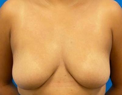Breast Augmentation Before & After Gallery - Patient 409272 - Image 1