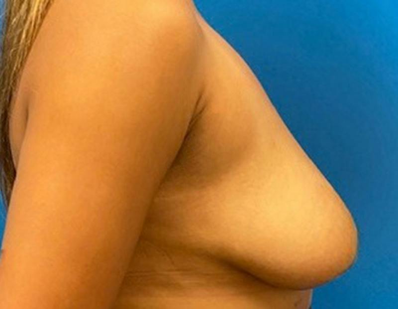 Breast Augmentation Before & After Gallery - Patient 409272 - Image 5