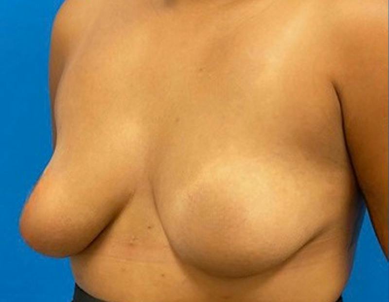 Breast Augmentation Before & After Gallery - Patient 409272 - Image 7