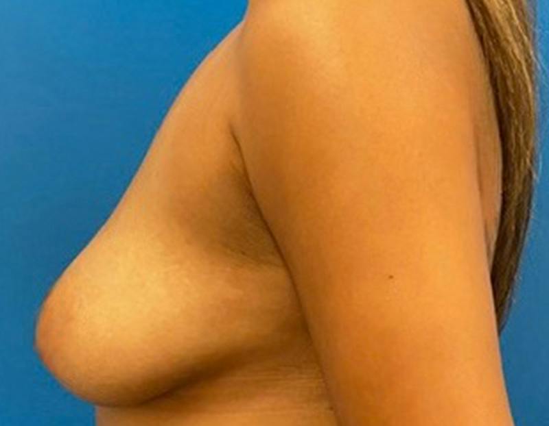 Breast Augmentation Before & After Gallery - Patient 409272 - Image 9
