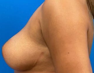 Breast Augmentation Before & After Gallery - Patient 409272 - Image 10
