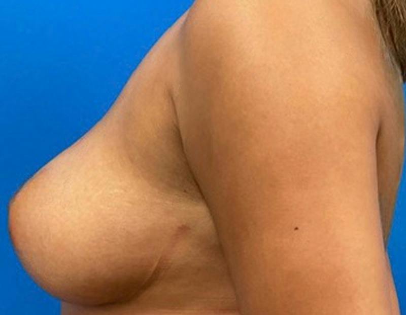 Breast Augmentation Before & After Gallery - Patient 409272 - Image 10
