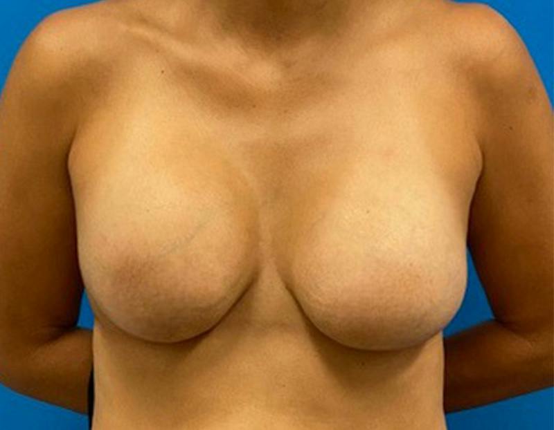Breast Augmentation Before & After Gallery - Patient 390426 - Image 1