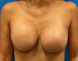 Breast Augmentation Before & After Gallery - Patient 390426 - Image 2