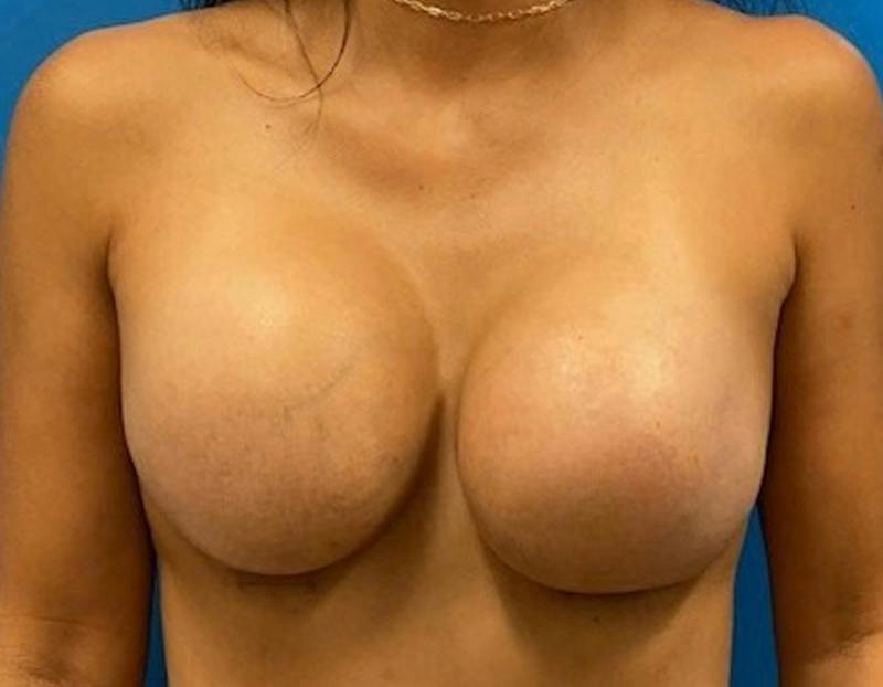 Breast Augmentation Before & After Gallery - Patient 390426 - Image 2