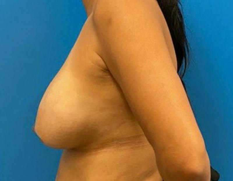 Breast Augmentation Before & After Gallery - Patient 390426 - Image 5