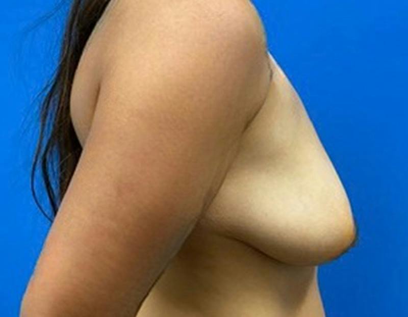 Breast Augmentation Before & After Gallery - Patient 457957 - Image 5