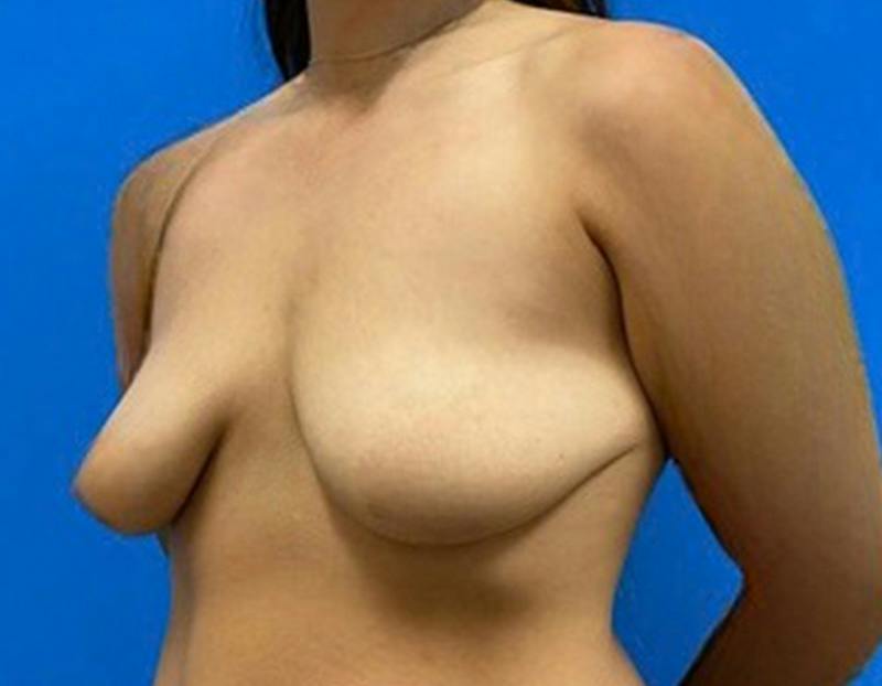 Breast Augmentation Before & After Gallery - Patient 457957 - Image 7