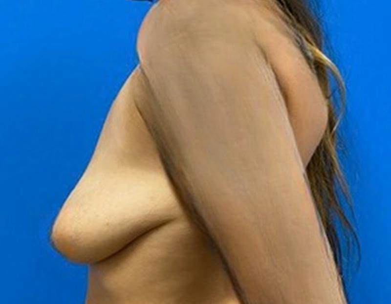 Breast Augmentation Before & After Gallery - Patient 457957 - Image 9