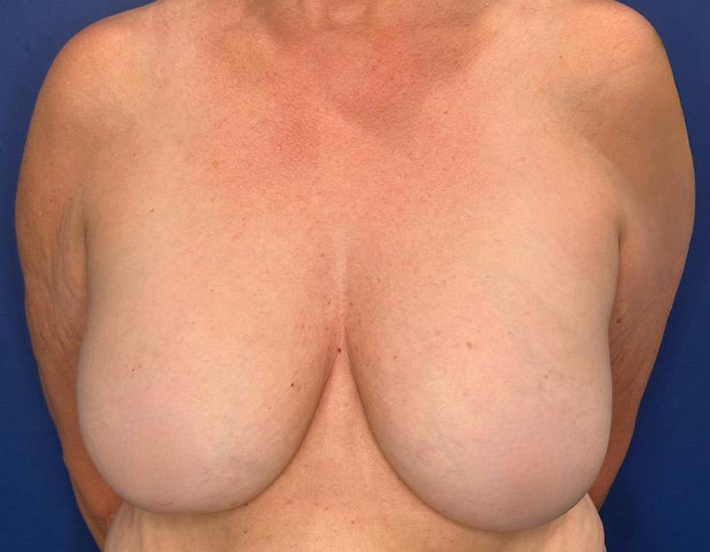 Breast Lift Before & After Gallery - Patient 215833 - Image 1