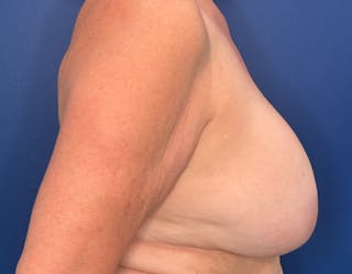 Breast Lift Before & After Gallery - Patient 215833 - Image 6