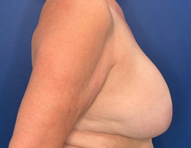 Breast Lift Before & After Gallery - Patient 215833 - Image 6