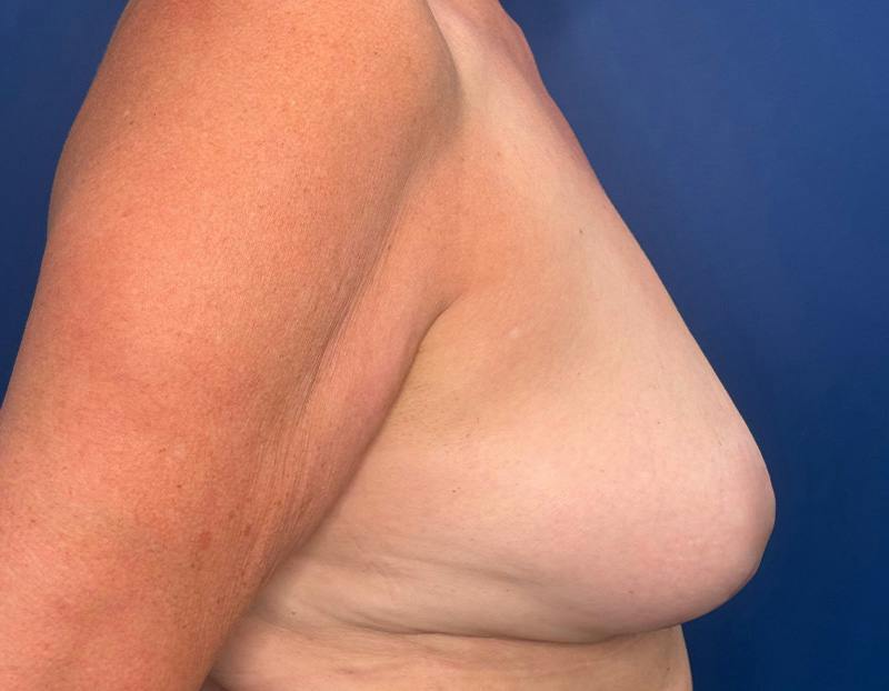 Breast Lift Before & After Gallery - Patient 215833 - Image 5